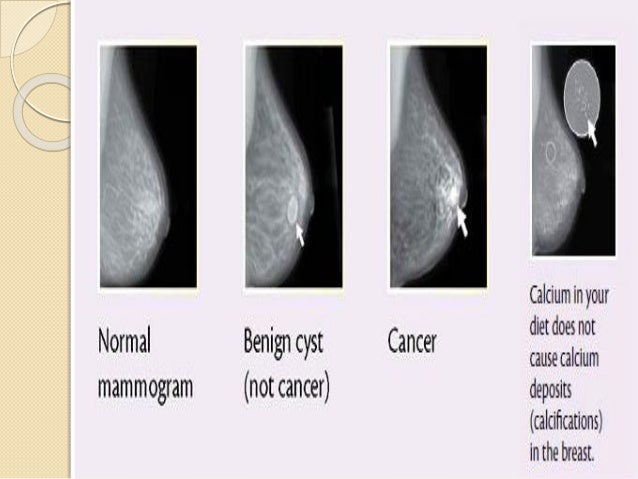 calcium deposits on the breast Calcium deposits on the breast